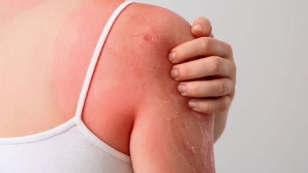 La quemadura solar