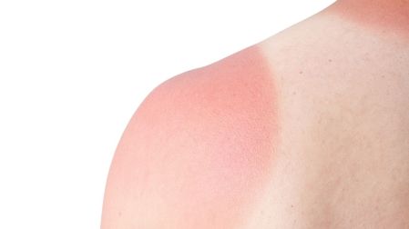 La quemadura solar podría provocar daños irreparables en tu piel