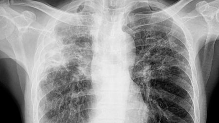 ¿La fibrosis quística es hereditaria?