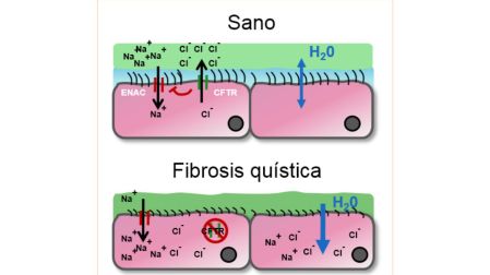 ¿La fibrosis quística es hereditaria?
