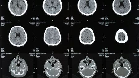 ¿Qué secuelas puede dejar la meningitis aunque una persona sobreviva?