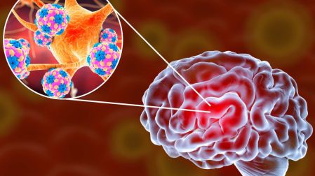 ¿Qué secuelas puede dejar la meningitis aunque una persona sobreviva?