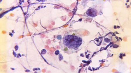 ¿Qué significa tener mamas densas y por qué puede dificultar detectar cáncer?