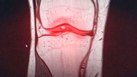 Hábitos que ayudan a proteger tus articulaciones de la artritis