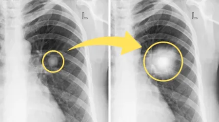 Los nódulos pulmonares pueden indicar un adenocarcinoma