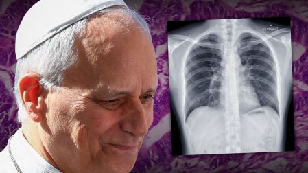 Al Papa le fue diagnosticado un adenocarcinoma