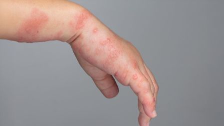 ¿Cuánto vive el virus del herpes zóster fuera del cuerpo y cómo prevenir su contagio?
