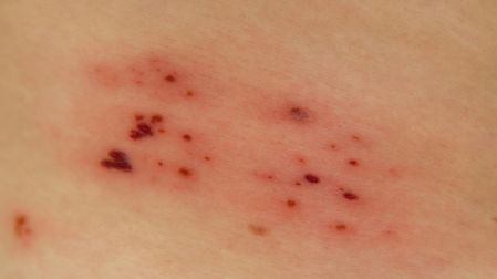 ¿Cuánto vive el virus del herpes zóster fuera del cuerpo y cómo prevenir su contagio?
