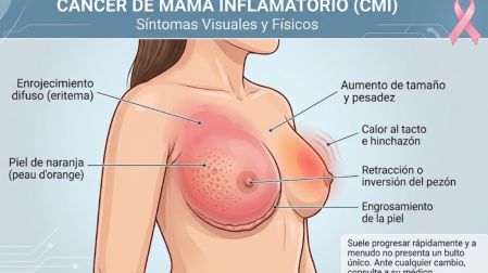 ¿Piel de naranja en el seno? Podría ser una señal de cáncer de mama inflamatorio
