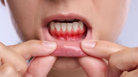 ¿Tus dientes se ven más largos Puede tratarse de recesión gingival