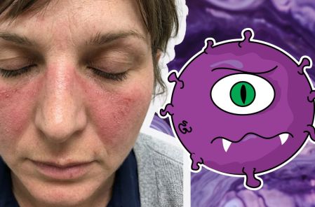 ¿Por qué el lupus afecta más a las mujeres y cómo detectarlo?
