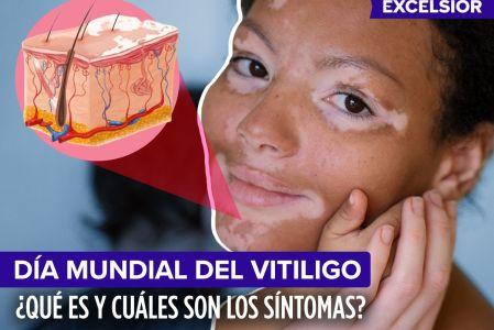 Ilustración de una parte de la piel y una mujer con vitiligo