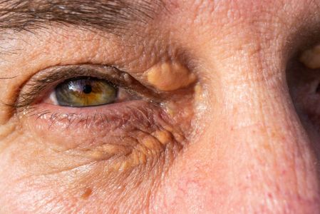 Colesterol en la mirada: 3 señales en tus ojos que revelan arterias obstruidas hoy