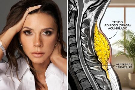 Famosos con Síndrome de Cushing o ‘joroba de búfalo’