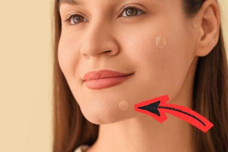 Los pimple patches se han popularizado como solución rápida contra el acné.
