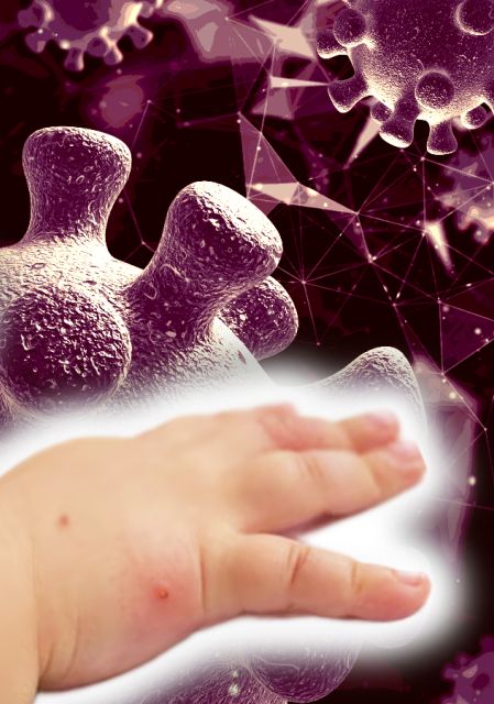 Sarampión en Durango