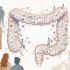 La colitis ulcerosa o enfermedad de Crohn