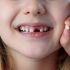 ¿Por qué se caen los dientes de leche antes de tiempo?