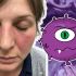 ¿Por qué el lupus afecta más a las mujeres y cómo detectarlo?