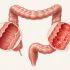 La enfermedad de Chrohn afecta el intestino grueso