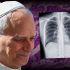 Al Papa le fue diagnosticado un adenocarcinoma