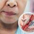 Trombólisis intravenosa y trombectomía: tratamientos para un ACV isquémico