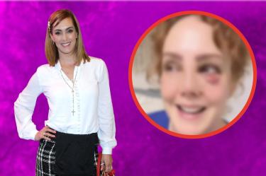 ¿Accidente o algo más? Fran Meric aparece con un ojo morado y preocupa a sus seguidores
