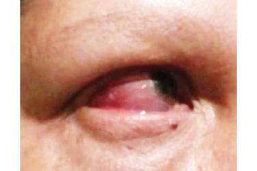 Maru sufrió un derrame en el ojo por el puñetazo que recibió. Foto: Especial