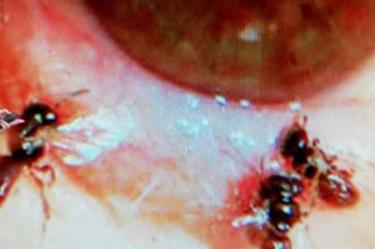 Acude al oftalmólogo por dolor; tenía 4 abejas en el ojo