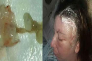 Mujer vive un año con enorme gusano en el cerebro