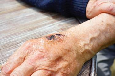 Se desconoce la causa por la cual aparecen las protuberancias; sin embargo, médicos consideran que son una forma de carcinoma de células escamosas; es decir, un tipo de cáncer de piel.