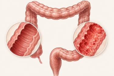 La enfermedad de Chrohn afecta el intestino grueso