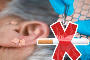 Cómo funciona la auriculoterapia para dejar de fumar