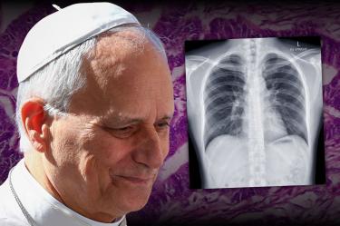 Al Papa le fue diagnosticado un adenocarcinoma