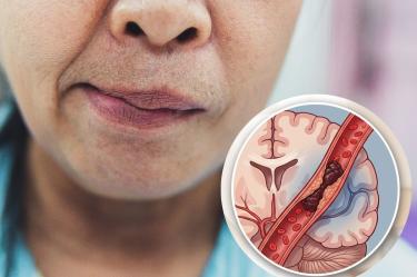 Trombólisis intravenosa y trombectomía: tratamientos para un ACV isquémico