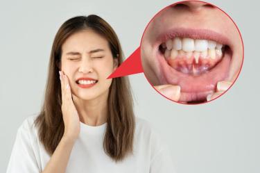 ¿Tus dientes se ven más largos Puede tratarse de recesión gingival