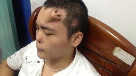 En la frente de Xiaolian, de 22 años, fue 'cultivada' una nariz para serle trasplantada después de que sufriera un grave accidente automovilístico. / Foto: Reuters