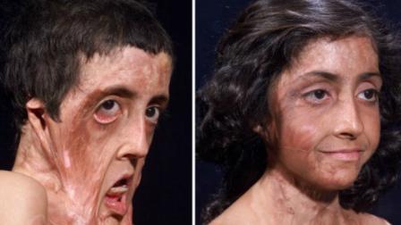 A los nueve años, Zubaida sufrió un accidente con fuego que desfiguró su rostro. (Foto: GrossMan Burn Foundation)