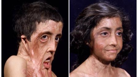A los nueve años en 2001, Zubaida sufrió un accidente con fuego que desfiguró su rostro.