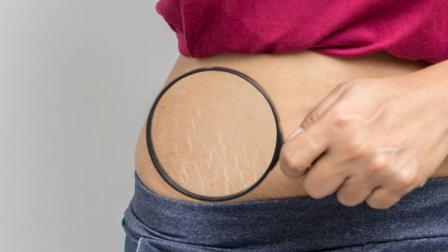 ¿Cómo quitar las estrías blancas?/ Cortesía: iStock