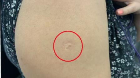 ¿Por qué los mexicanos tenemos esta cicatriz en el brazo? Cortesía: iStock