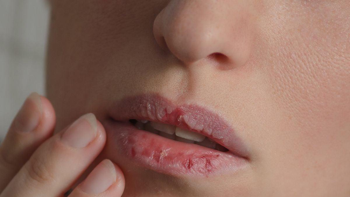 Labios partidos: por qué se agrietan y cómo evitarlo
