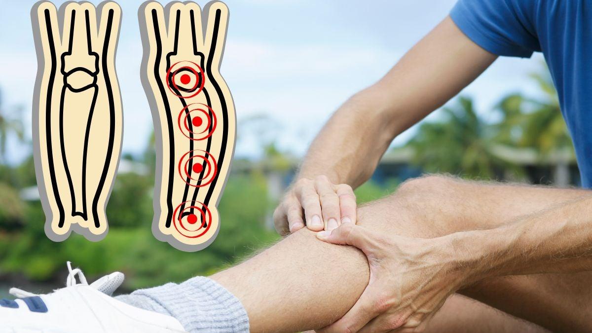 ¿Qué es el Síndrome de Sudeck y por qué se conmemora?