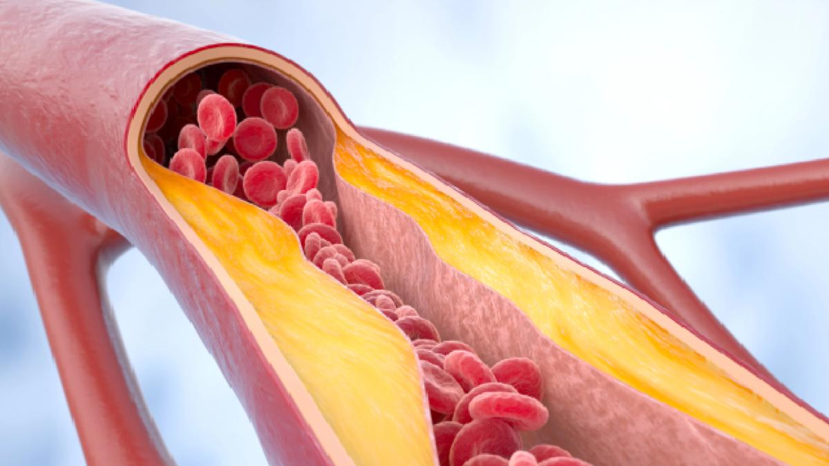 <![CDATA[Nueva píldora reduce colesterol LDL hasta 65%, según estudios]]>