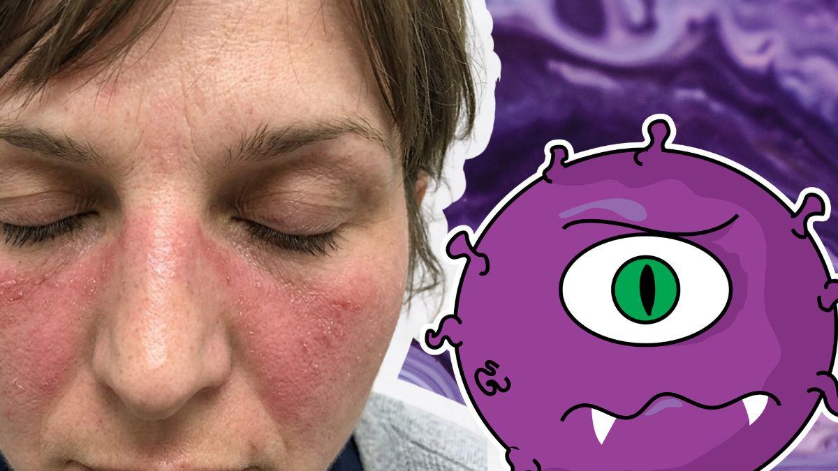 <![CDATA[¿Por qué el lupus afecta más a las mujeres y cómo detectarlo?]]>
