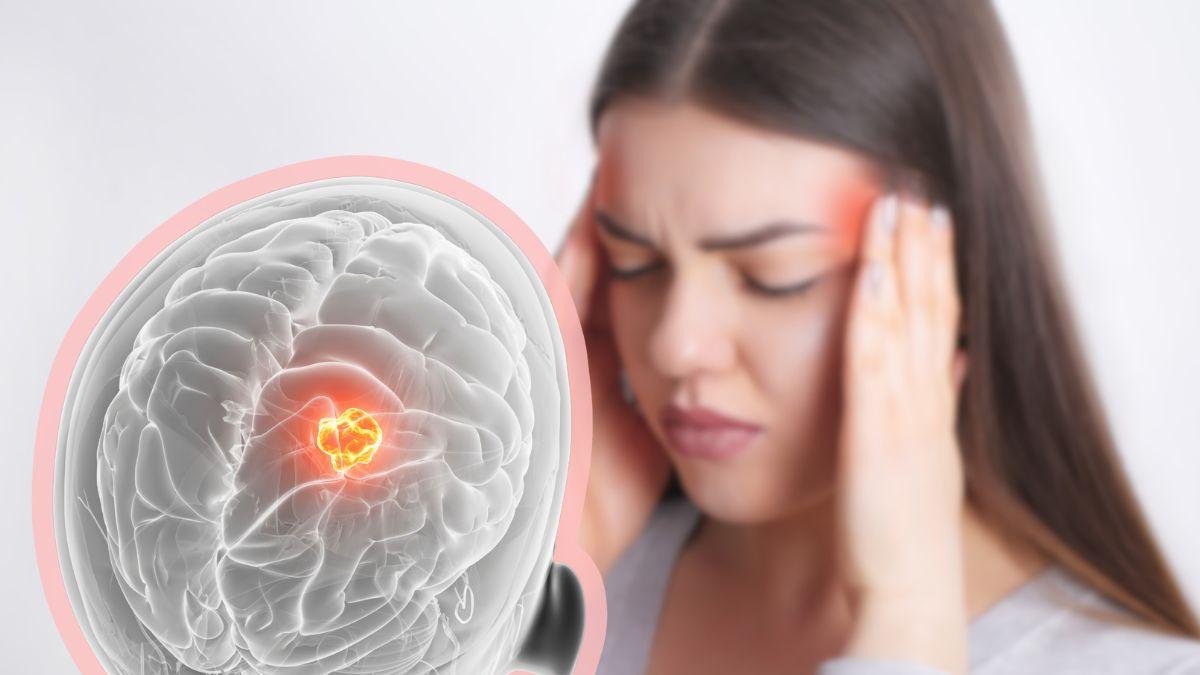 <![CDATA[¿Cuándo el dolor de cabeza puede ser síntoma de tum