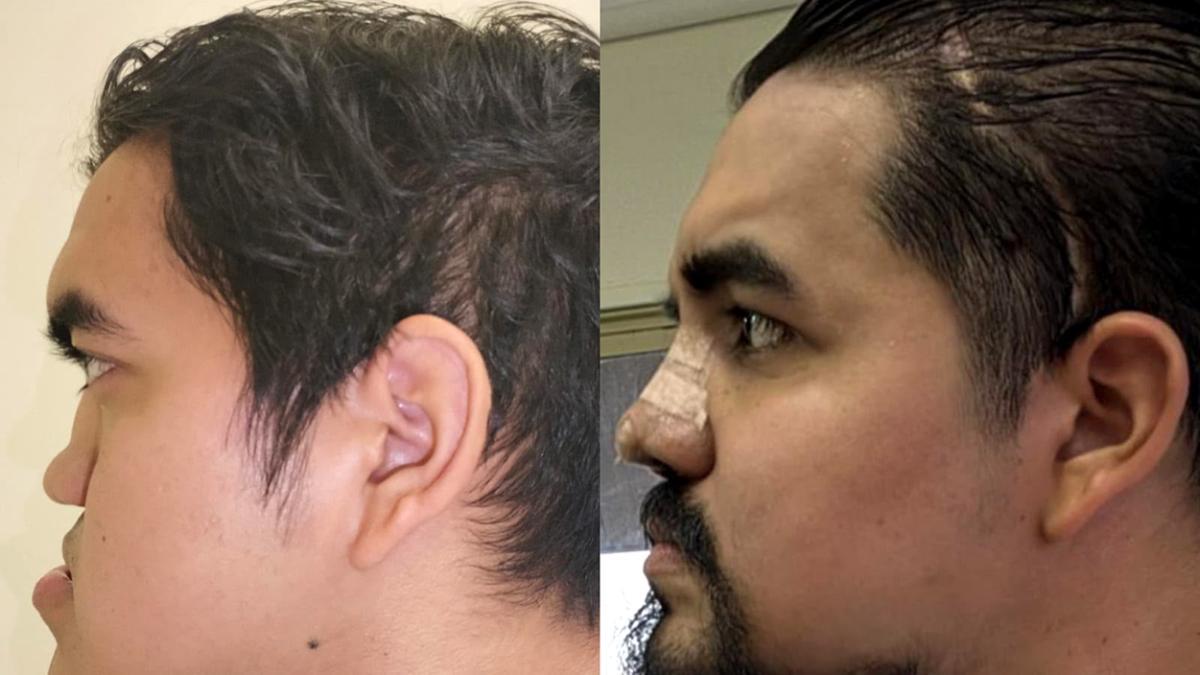 Médicos del IMSS logran reconstrucción facial de un joven tras 25 años